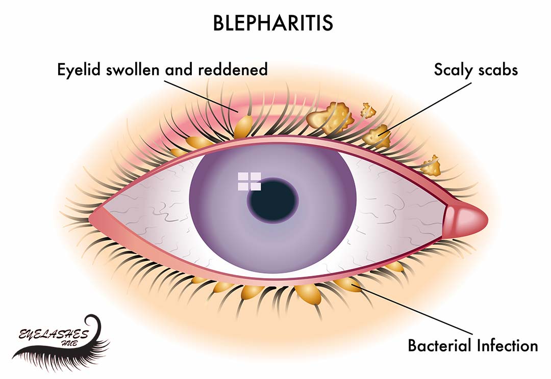 Blepharitis from Eyelash Extensions: Tips & Relief - CorneaCare